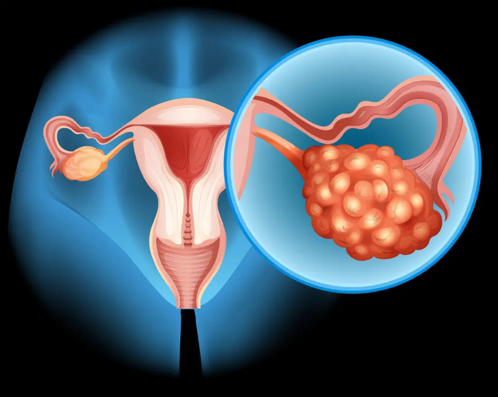 Role of cetrorelix